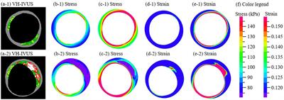 Predicting Coronary Stenosis Progression Using Plaque Fatigue From IVUS-Based Thin-Slice Models: A Machine Learning Random Forest Approach